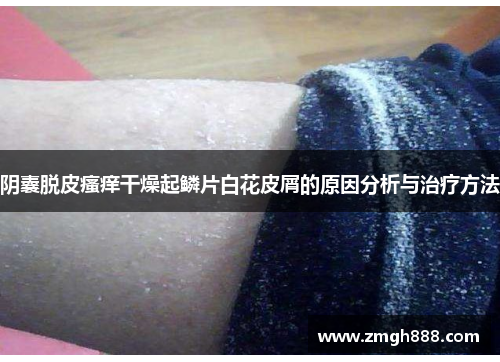 阴囊脱皮瘙痒干燥起鳞片白花皮屑的原因分析与治疗方法